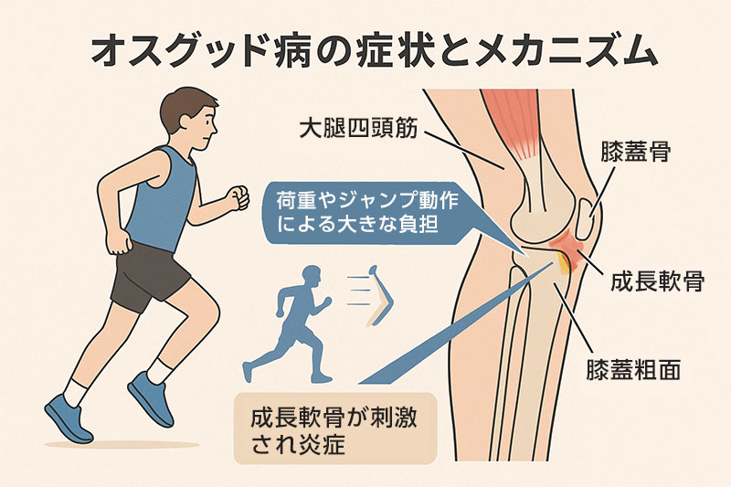 オスグット病の症状とメカニズム